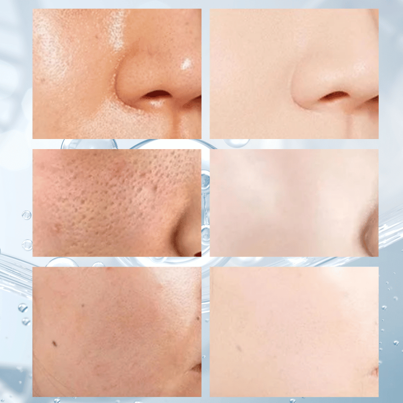 Máscara de limpeza, Controle de oleosidade e Anti Acne